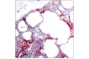Immunohistochemical analysis of paraffin-embedded human breast carcinoma tissue using ATF2(Phospho-Ser62 or 44) Antibody. (ATF2 antibody  (pSer62))