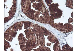 Immunohistochemical staining of paraffin-embedded Human breast tissue using anti-DSTN mouse monoclonal antibody.