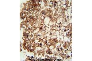 CD11b antibody (N-term) immunohistochemistry analysis in formalin fixed and paraffin embedded human hepatocarcinoma followed by peroxidase conjugation of the secondary antibody and DAB staining.