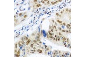Immunohistochemical analysis of IRF-6 staining in human colon cancer formalin fixed paraffin embedded tissue section. (IRF6 antibody)