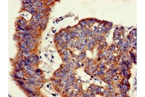 Immunohistochemistry of paraffin-embedded human colon cancer using ABIN7145493 at dilution of 1:100 (GLB1 antibody  (AA 317-455))