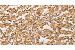 Immunohistochemistry of paraffin-embedded Human thyroid cancer tissue using ARMCX1 Polyclonal Antibody at dilution 1:40