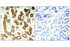 Immunohistochemical analysis of paraffin-embedded human breast carcinoma tissue using Keratin 8 (Ab-73) antibody (E021307). (Cytokeratin 18 antibody)