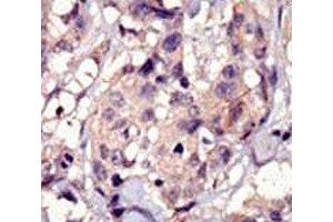 IHC analysis of FFPE human breast carcinoma tissue stained with PDGFRA antibody (PDGFRA antibody  (AA 1048-1077))