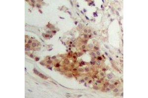 Immunohistochemical analysis of CAR staining in human breast cancer formalin fixed paraffin embedded tissue section. (NR1I3 antibody)
