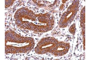 IHC-P Image Immunohistochemical analysis of paraffin-embedded human colon carcinoma, using HLA-DQB2, antibody at 1:500 dilution. (HLA-DQB2 antibody)