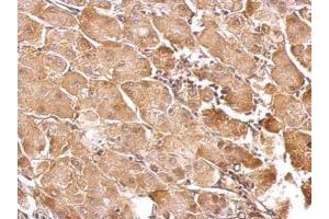 IHC-P Image GSTT1 antibody detects GSTT1 protein at cytosol on human gastric cancer by immunohistochemical analysis. (GSTT1 antibody)