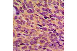 Immunohistochemical analysis of NF1 staining in human breast cancer formalin fixed paraffin embedded tissue section. (Neurofibromin 1 antibody  (Center))