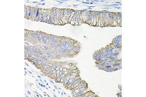 Immunohistochemistry of paraffin-embedded human colon carcinoma using ACVR2A antibody at dilution of 1:100 (x40 lens). (ACVR2A antibody)