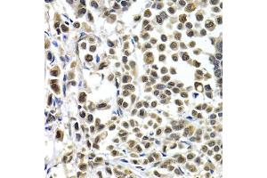 Immunohistochemistry of paraffin-embedded human breast cancer using IRF2 antibody. (IRF2 antibody)