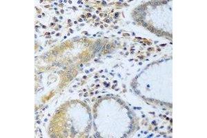 Immunohistochemical analysis of Desmoplakin staining in human stomach cancer formalin fixed paraffin embedded tissue section. (Desmoplakin antibody)