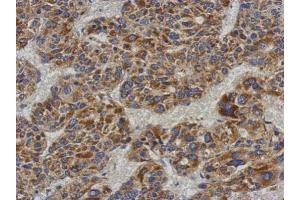 IHC-P Image Immunohistochemical analysis of paraffin-embedded human hepatoma, using ACADL, antibody at 1:500 dilution. (ACADL antibody  (N-Term))