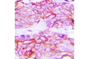 Immunohistochemical analysis of VEGFR2 (pY1214) staining in human breast cancer formalin fixed paraffin embedded tissue section.