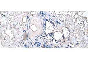 Immunohistochemistry of paraffin-embedded Human thyroid cancer tissue using PTP4A1 Polyclonal Antibody at dilution of 1:45(x200) (PTP4A1 antibody)