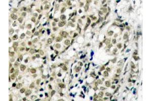 Immunohistochemical analysis of paraffin-embedded human prostate cancer tissue using AR polyclonal antibody . (Androgen Receptor antibody)
