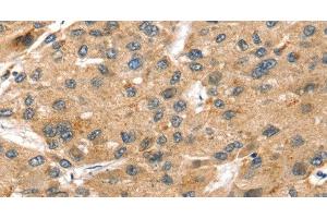 Immunohistochemistry of paraffin-embedded Human liver cancer using SORT1 Polyclonal Antibody at dilution of 1:35 (Sortilin 1 antibody)