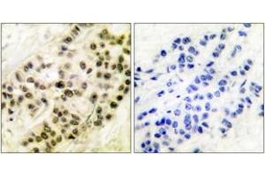 Immunohistochemistry analysis of paraffin-embedded human breast carcinoma tissue, using Cyclin B1 (Ab-126) Antibody. (Cyclin B1 antibody  (AA 91-140))