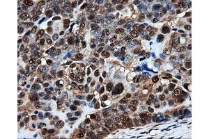 Immunohistochemical staining of paraffin-embedded Adenocarcinoma of breast tissue using anti-PSMC3 mouse monoclonal antibody. (PSMC3 antibody)