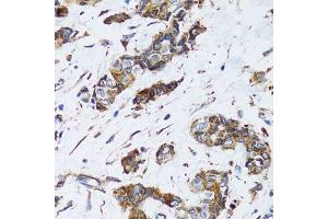 Immunohistochemistry of paraffin-embedded human breast cancer using PGRMC1 antibody.