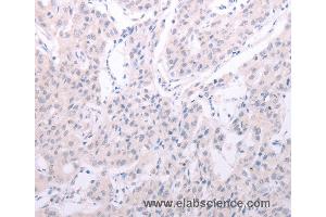 Immunohistochemistry of Human lung cancer using SPATA6 Polyclonal Antibody at dilution of 1:40 (SPATA6 antibody)