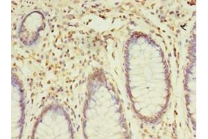 Immunohistochemistry of paraffin-embedded human colon cancer using ABIN7170377 at dilution of 1:100 (SNX24 antibody  (AA 1-169))