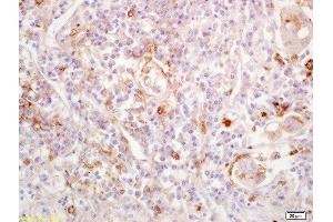 Formalin-fixed and paraffin embedded human lung carcinoma labeled with Anti-EDG1/CD363/S1P1 Polyclonal Antibody, Unconjugated  at 1:200 followed by conjugation to the secondary antibody and DAB staining.