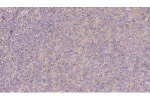 ABIN6273067 at 1/100 staining Human lymph cancer tissue by IHC-P. (PRPH2 antibody  (Internal Region))
