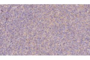 ABIN6273067 at 1/100 staining Human lymph cancer tissue by IHC-P. (PRPH2 antibody  (Internal Region))