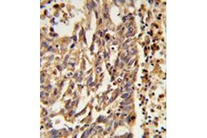 Formalin-fixed and paraffin-embedded human lung carcinoma reacted with KIF11 Antibody (N-term) followed which was peroxidase-conjugated to the secondary antibody, followed by DAB staining. (KIF11 antibody  (N-Term))