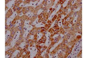 IHC image of ABIN7127339 diluted at 1:100 and staining in paraffin-embedded human liver cancer performed on a Leica BondTM system. (Recombinant Angiopoietin 2 antibody)