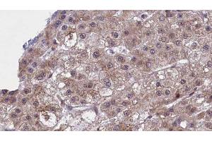 ABIN6277451 at 1/100 staining Human liver cancer tissue by IHC-P. (SLC22A8 antibody  (N-Term))
