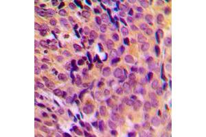 Immunohistochemical analysis of MRPL17 staining in human breast cancer formalin fixed paraffin embedded tissue section. (MRPL17 antibody  (C-Term))