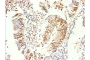 Immunohistochemistry of paraffin-embedded human colon cancer using ABIN7164919 at dilution of 1:100
