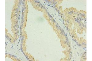 Immunohistochemistry of paraffin-embedded human prostate cancer using ABIN7158804 at dilution of 1:100 (LAMP2 antibody  (AA 54-268))