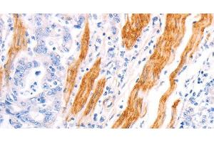 Immunohistochemistry of paraffin-embedded Human gastric cancer using TPM1 Polyclonal Antibody at dilution of 1:40 (Tropomyosin antibody)