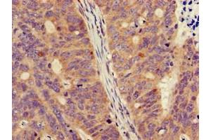 Immunohistochemistry of paraffin-embedded human colon cancer using ABIN7160758 at dilution of 1:100 (FPR3 antibody  (AA 307-353))