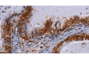 Immunohistochemistry of paraffin-embedded Human esophagus cancer using MECP2 Polyclonal Antibody at dilution of 1:60 (MECP2 antibody)
