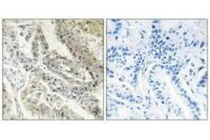 Immunohistochemistry analysis of paraffin-embedded human lung carcinoma tissue, using CRBP III antibody. (Retinol Binding Protein 5 antibody)