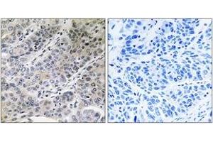 Immunohistochemistry analysis of paraffin-embedded human lung carcinoma tissue, using BRP44 Antibody.