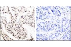 Immunohistochemistry analysis of paraffin-embedded human breast carcinoma, using Elk1 (Phospho-Thr417) Antibody. (ELK1 antibody  (pThr417))