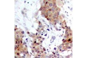 Immunohistochemical analysis of FOXO1/3 staining in human breast cancer formalin fixed paraffin embedded tissue section. (FOXO1 antibody)