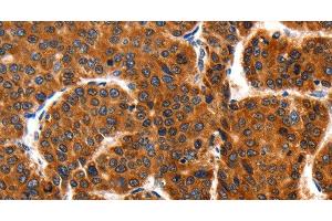 Immunohistochemistry of paraffin-embedded Human liver cancer using HSP75 Polyclonal Antibody at dilution of 1:100 (TRAP1 antibody)