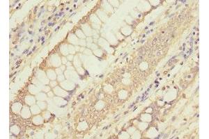Immunohistochemistry of paraffin-embedded human colon cancer using ABIN7160191 at dilution of 1:100 (MTHFD1L antibody  (AA 759-978))