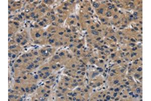 The image on the left is immunohistochemistry of paraffin-embedded Human liver cancer tissue using ABIN7191127(ITGA11 Antibody) at dilution 1/40, on the right is treated with synthetic peptide. (ITGA11 antibody)