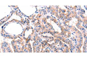 Immunohistochemistry of paraffin-embedded Human thyroid cancer tissue using GRK2 Polyclonal Antibody at dilution 1:87 (GRK2 antibody)