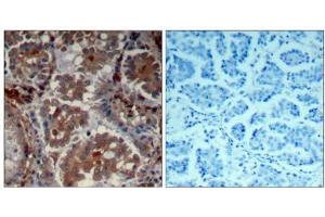 Immunohistochemical analysis of paraffin-embedded human Lung carcinoma tissue using mTOR (Ab-2448) Antibody (E021214). (MTOR antibody)