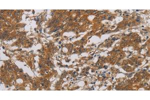 Immunohistochemistry of paraffin-embedded Human gastic cancer using CNDP1 Polyclonal Antibody at dilution of 1:30 (CNDP1 antibody)