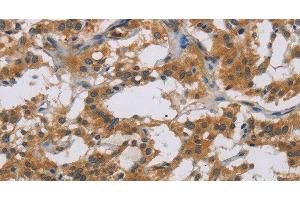 Immunohistochemistry of paraffin-embedded Human thyroid cancer tissue using IL18R1 Polyclonal Antibody at dilution 1:40 (IL18R1 antibody)