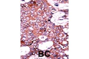 Formalin-fixed and paraffin-embedded human cancer tissue reacted with CDC25A (phospho S75) polyclonal antibody  which was peroxidase-conjugated to the secondary antibody followed by AEC staining. (CDC25A antibody  (pSer76))