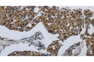 Immunohistochemistry of paraffin-embedded Human breast cancer using PRKAR1B Polyclonal Antibody at dilution of 1:70 (PRKAR1B antibody)